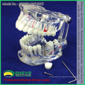 SELL 12567 Life Size Transparent Dental with Implant Tooth